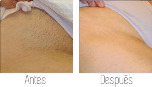 ayd-foliculitis