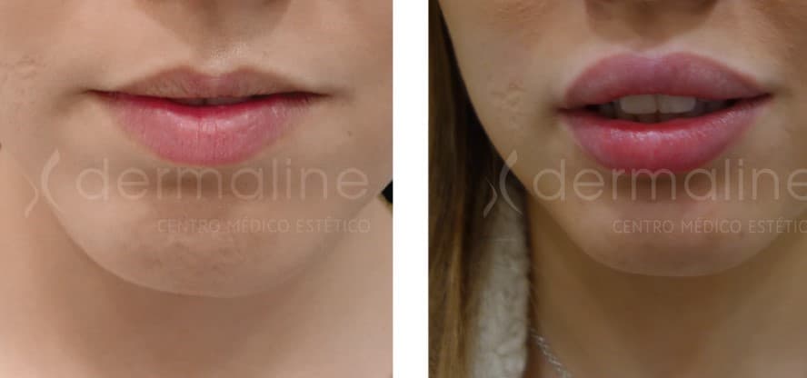 Labios dermaline (1)