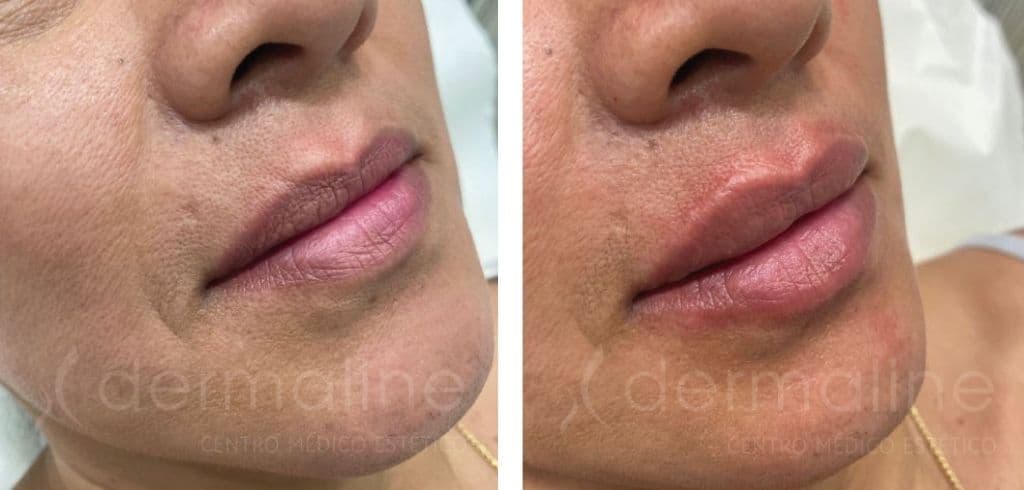 Labios dermaline