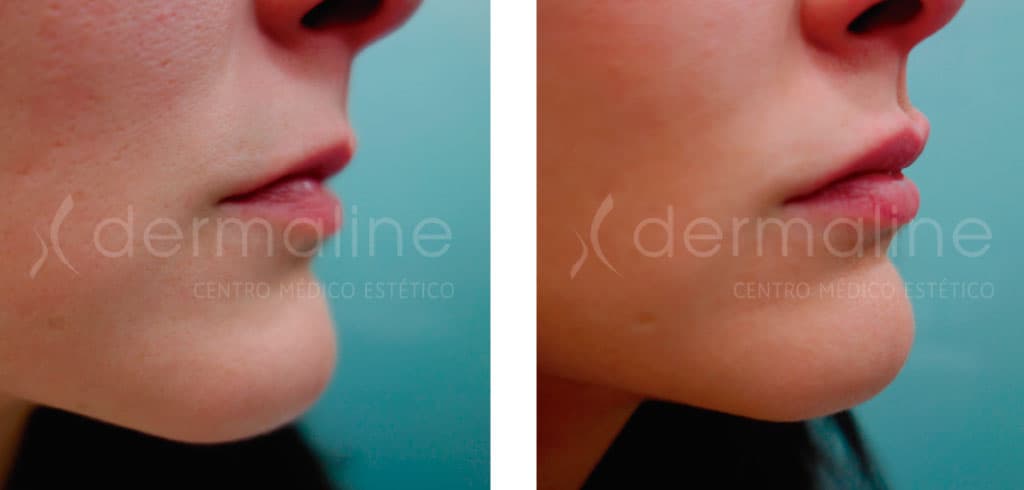 Labios dermaline (4)