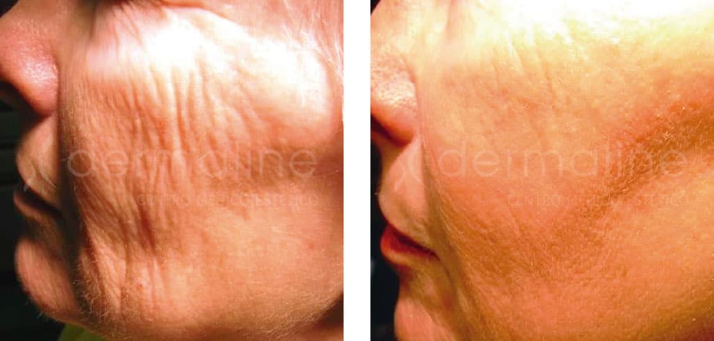 Láser facial dermaline (2)