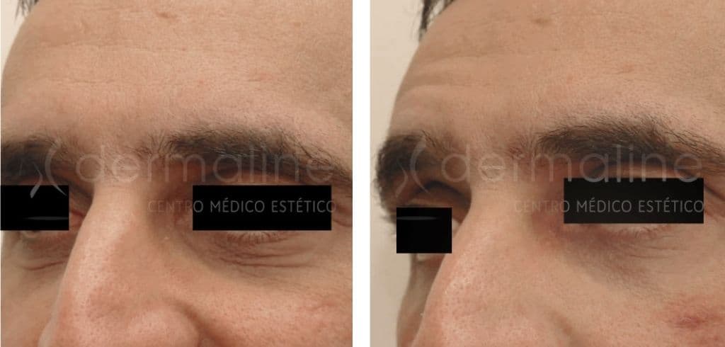 Ojeras dermaline (2)