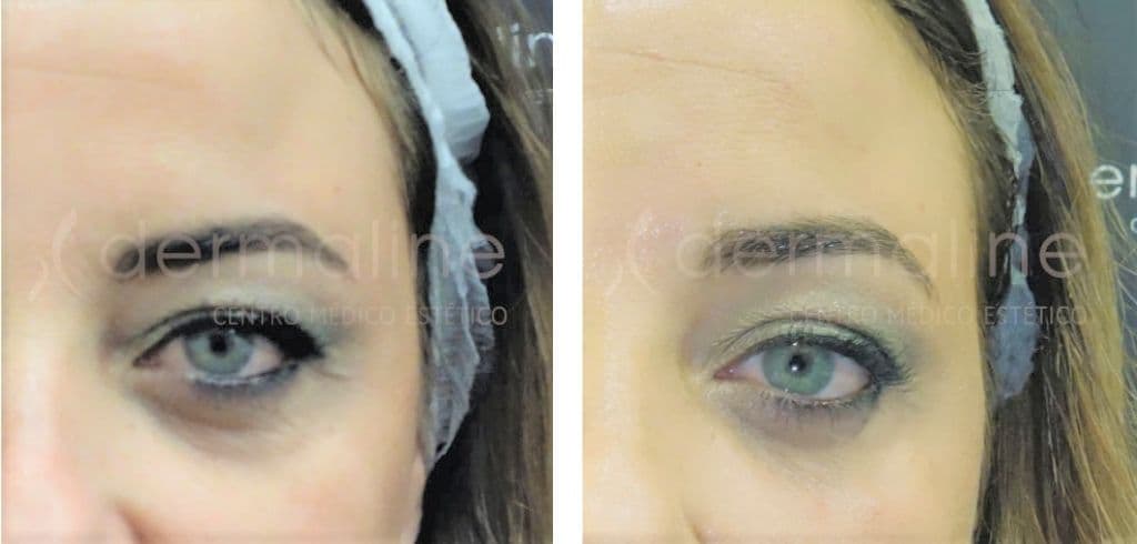 Ojeras dermaline (3)