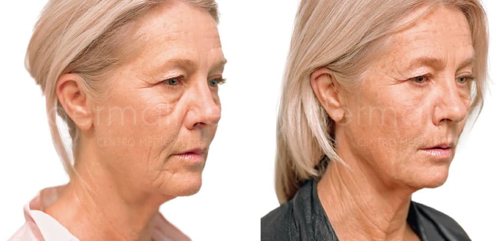 Rejuvenecimiento facial dermaline (1)