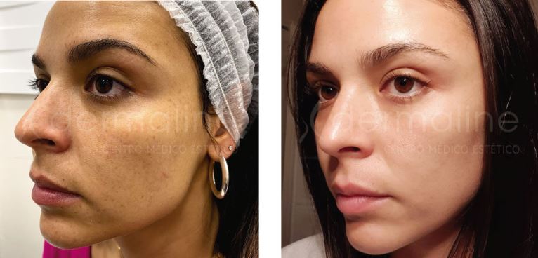 Rejuvenecimiento facial dermaline (3)