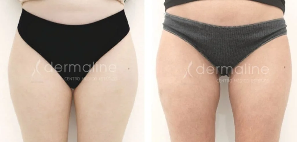 laser-lipolisis-dermaline-madrid (1)