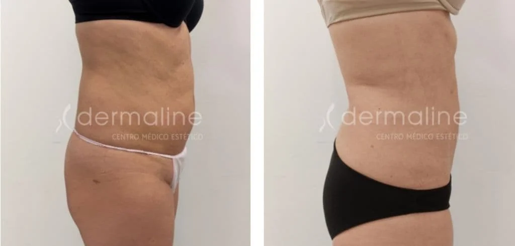 laser-lipolisis-dermaline-madrid (3)