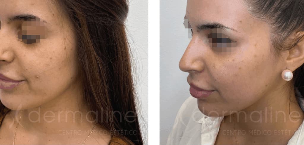 skin pen dermaline