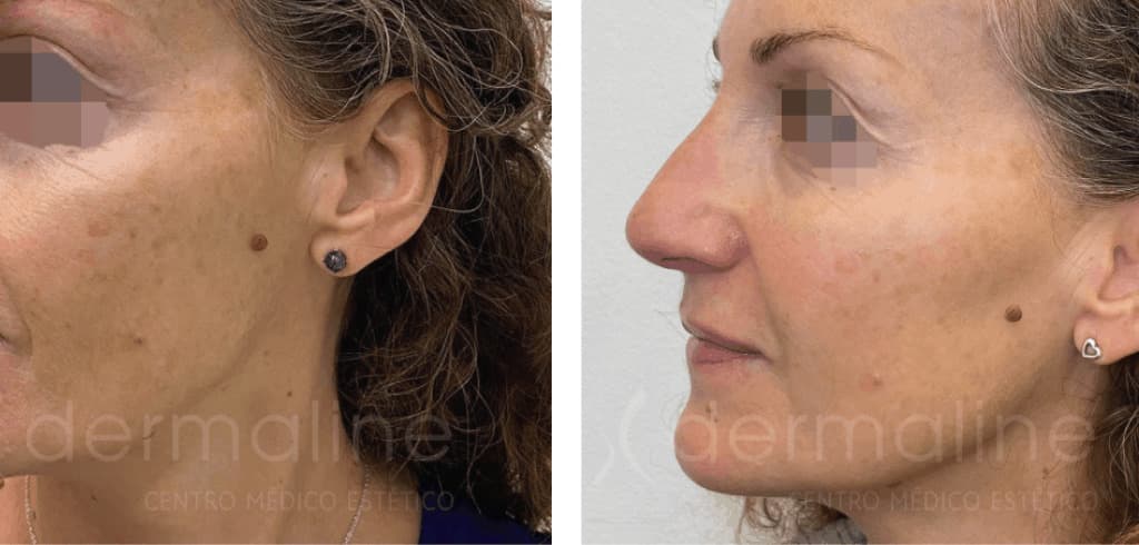 skin pen dermaline