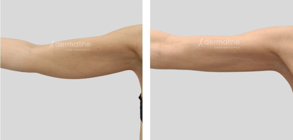 Accent prime dermaline