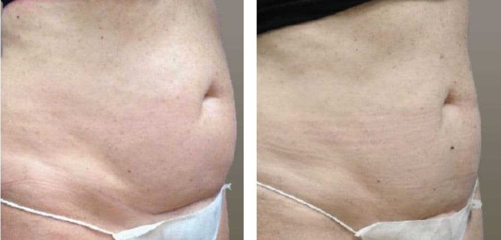 Accent prime dermaline